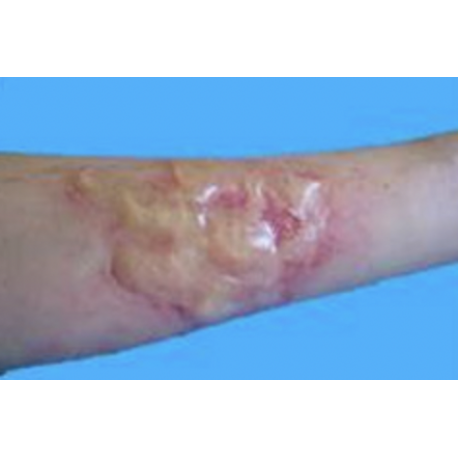 Simulation Brûlure grave