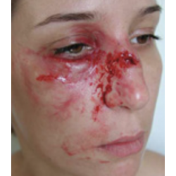 MAQUILLAGE FRACTURE DU NEZ AVEC POMETTE GONFLEE