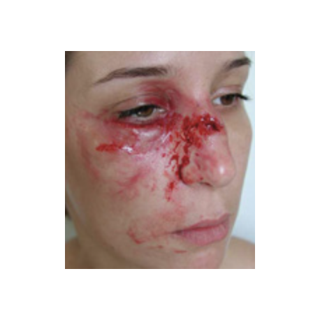 MAQUILLAGE FRACTURE DU NEZ AVEC POMETTE GONFLEE MAQUILLAGE FRACTURE DU NEZ AVEC POMETTE GONFLEE
