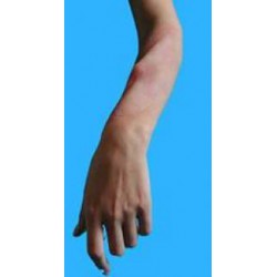 Fracture interne avant bras, tibia ou clavicule