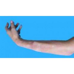 Fracture interne avant bras, tibia ou clavicule
